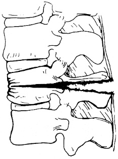 d:\viktoro\neuroscience\trs. spinal trauma\00. pictures\chance fracture (scheme).jpg