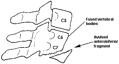 d:\viktoro\neuroscience\trs. spinal trauma\00. pictures\extension teardrop fracture (schema).gif