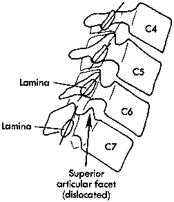 d:\viktoro\neuroscience\trs. spinal trauma\00. pictures\unilateral facet dislocation (schema) 4.gif