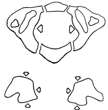 d:\viktoro\neuroscience\trs. spinal trauma\00. pictures\jefferson fracture (schema) 3.gif