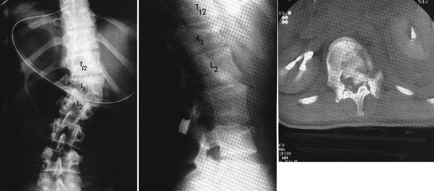 d:\viktoro\neuroscience\trs. spinal trauma\00. pictures\lateral flexion injury (x-ray, ct).jpg