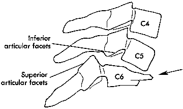 d:\viktoro\neuroscience\trs. spinal trauma\00. pictures\bilateral facet dislocation (schema).gif