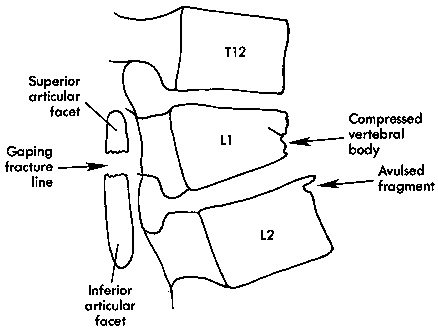 d:\viktoro\neuroscience\trs. spinal trauma\00. pictures\rotation fracture-dislocation of lumbar spine (scheme) 2.gif