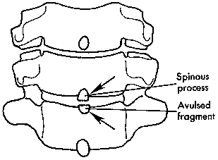 d:\viktoro\neuroscience\trs. spinal trauma\00. pictures\clay\'s shoveler\'s fracture (schema) 3.gif